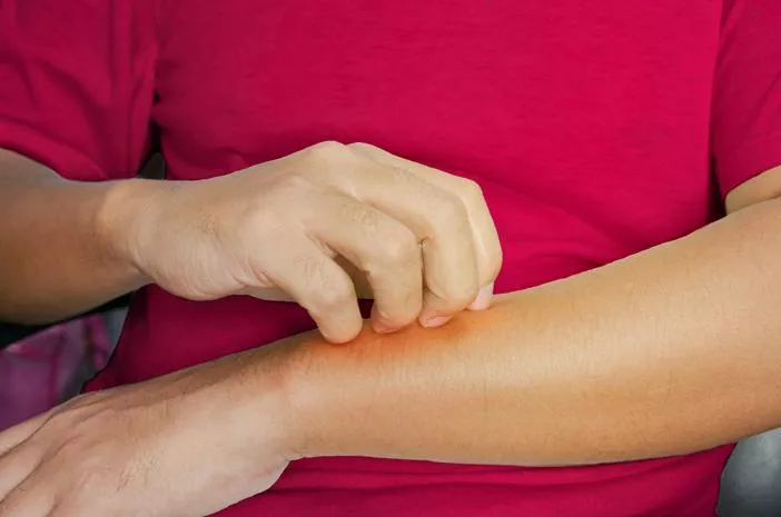 Harus Tahu, 6 Cara Mengatasi Dermatitis Kontak 