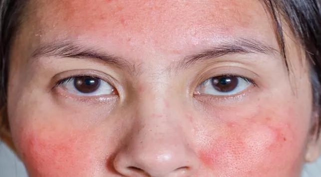 Muncul Ruam atau Bengkak, Kenali Ciri-Ciri Alergi Kosmetik