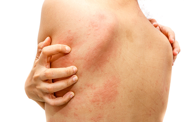 Cara mencegah penyakit menular melalui kulit adalah