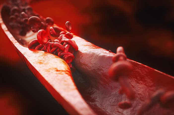 Siapa yang Paling Berisiko Mengidap Aterosklerosis?