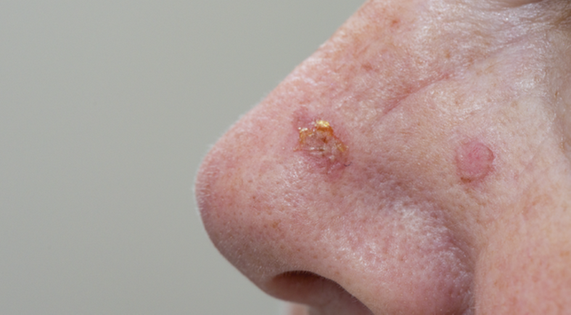 Actinic Keratosis