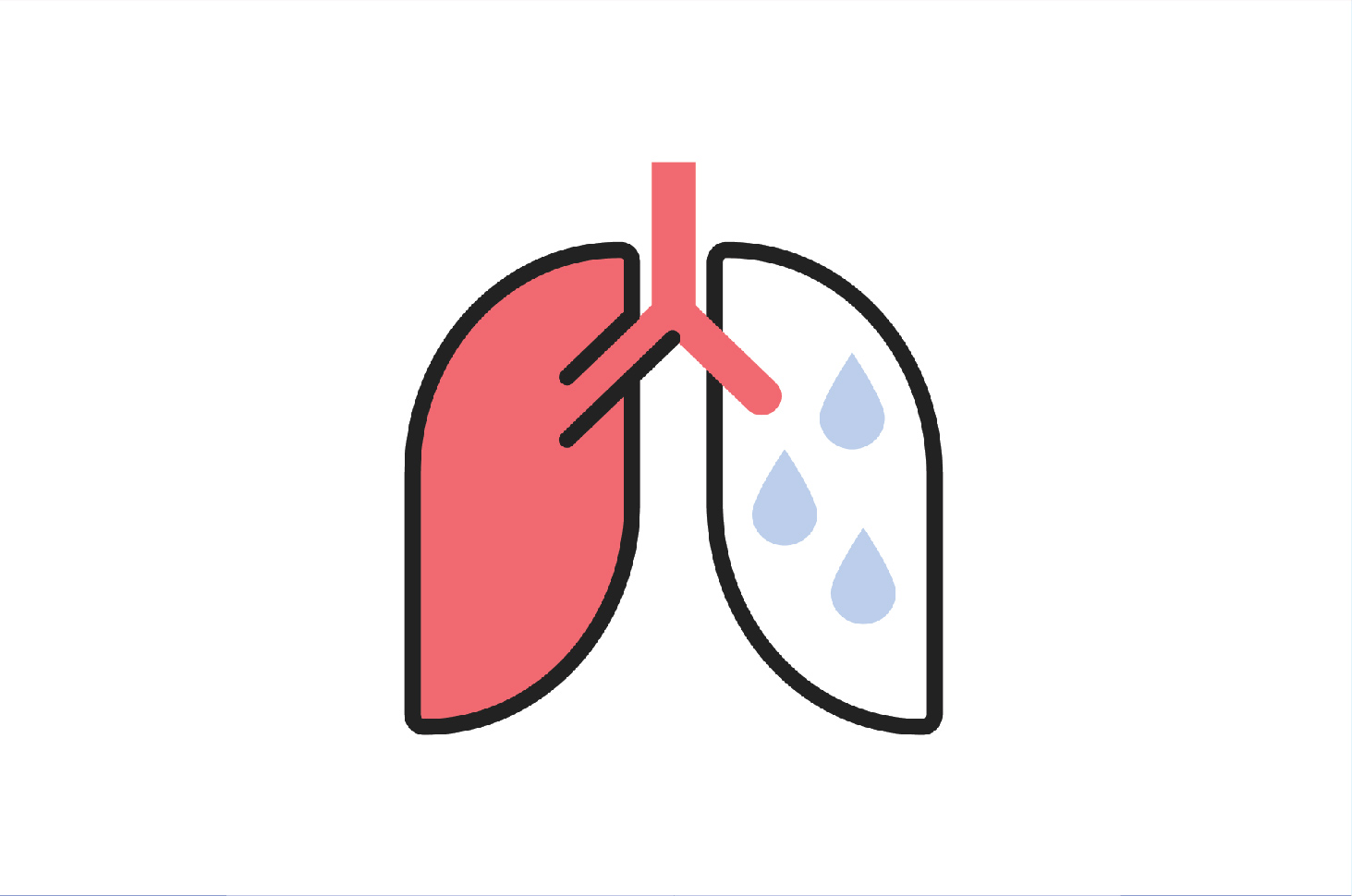 Pneumonia merupakan sebutan lain dari penyakit
