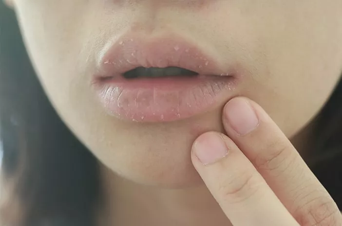 Cara Alami Mengatasi Bibir Kering saat Puasa