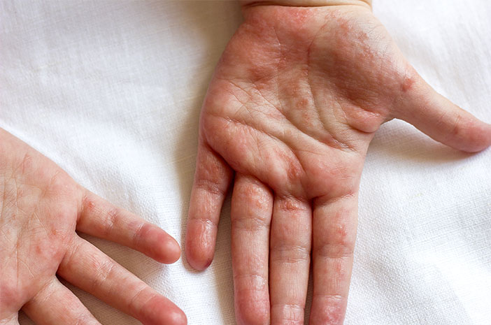 Wanita yang Stres Lebih Rentan Alami Psoriasis