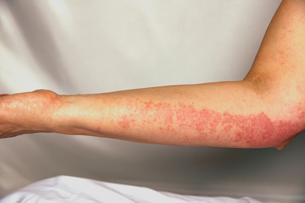 6 Fakta yang Perlu Dipahami tentang Henoch-Schonlein Purpura