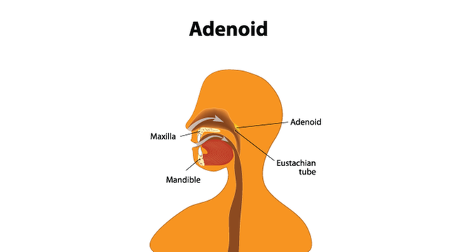 Adenoiditis