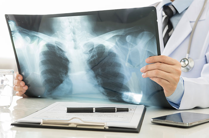 Terapi Oksigen Bisa Dilakukan untuk Atasi Asbestosis 