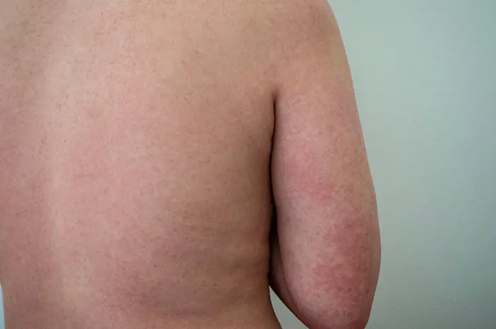 Mitos atau Fakta, Alergi Serbuk Sari Bisa Sebabkan Biduran