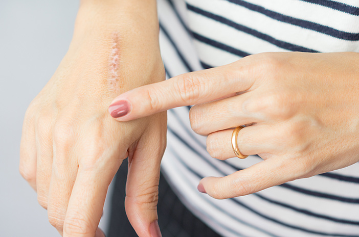 Pernah Mengalami Luka Bakar Perlu Divaksin Tetanus, Benarkah?