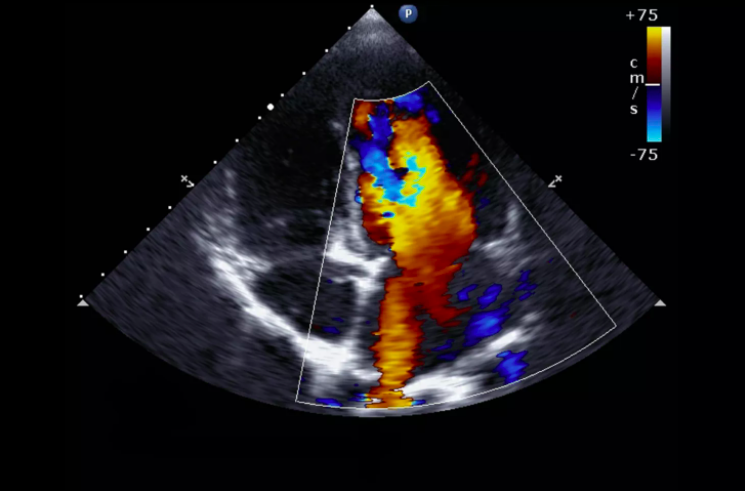 USG Doppler