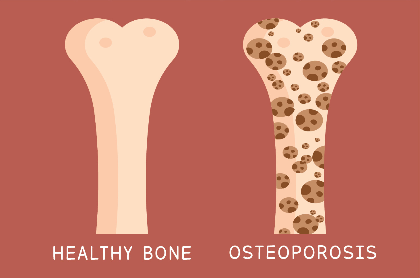 Sering Dilupakan, Osteoporosis bisa Jadi Silent Killer
