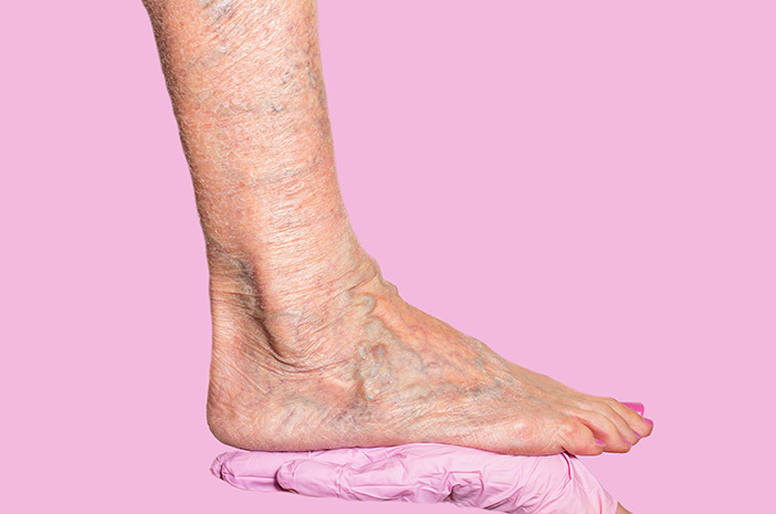 Mitos atau Fakta Varises Picu Chronic Venous Insufficiency