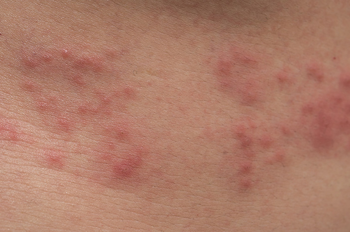 Inilah Kondisi yang Bisa Meningkatkan Risiko Herpes Zoster