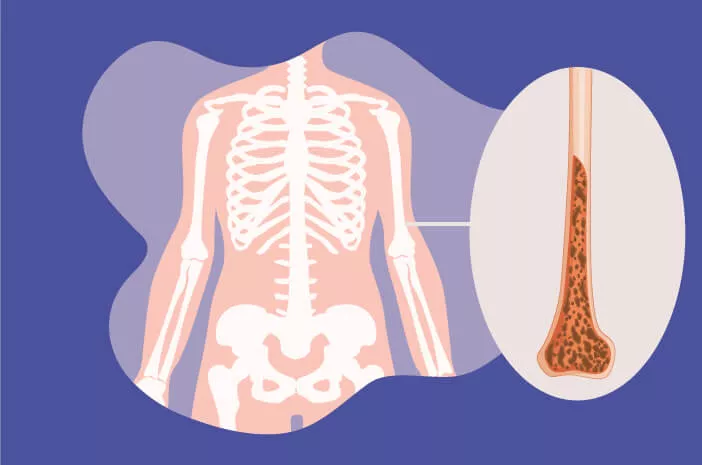 Ketahui Penyebab Terjadinya Osteoporosis