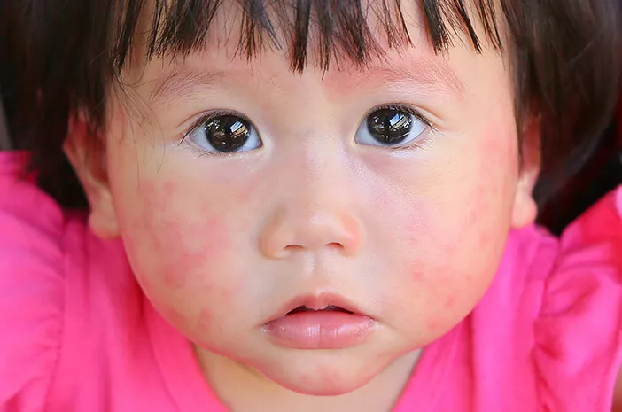 Disebabkan Gen, Dermatitis Atopik Umum Menyerang Kakak Adik
