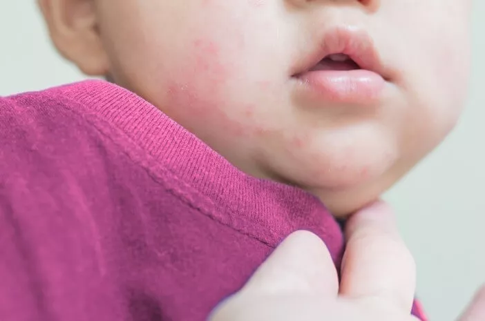 Bayi Rentan Terkena Dermatitis Kontak, Ini Sebabnya