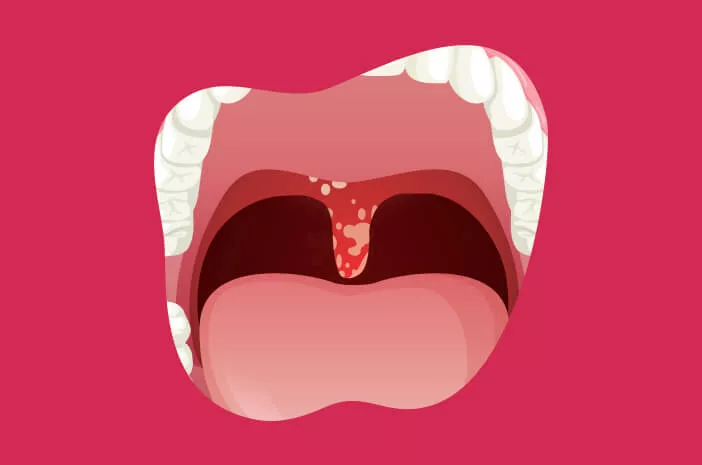 Lakukan 7 Hal ini untuk Mencegah Terkena Oral Thrush 