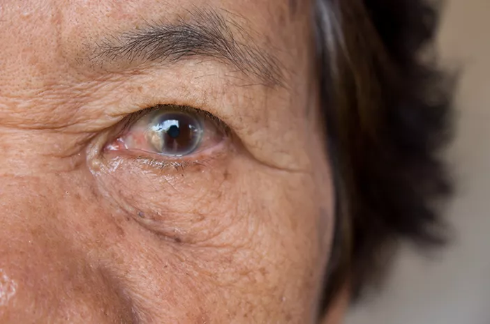 Penyakit Katarak Senilis Bisa Memicu Glaukoma