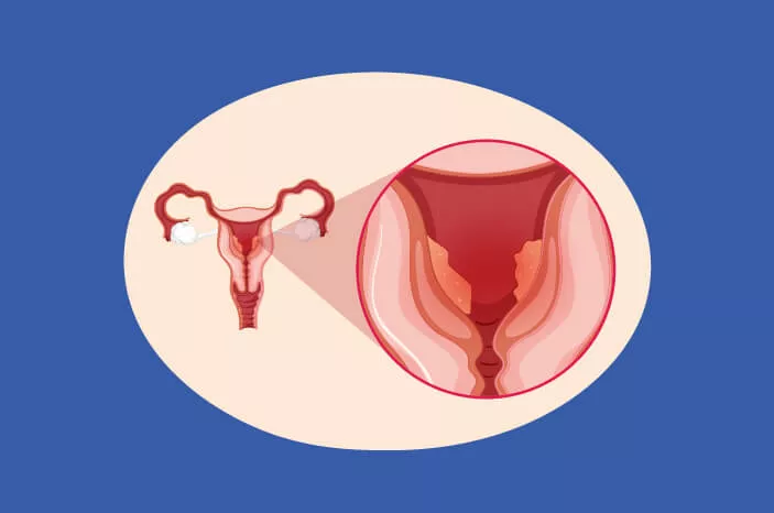 Apakah Penyakit Kanker Endometrium Bisa Menurun?