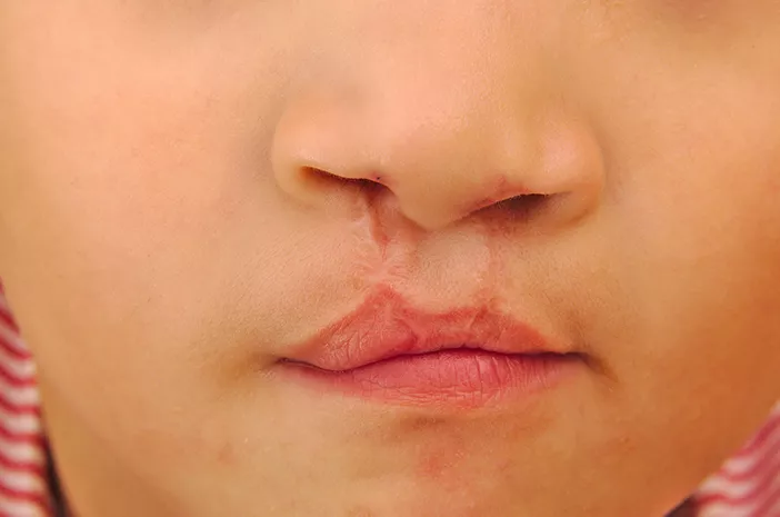 5 Penyebab Bayi Lahir dengan Bibir Sumbing