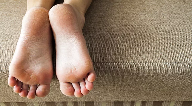 Atasi Kaki Pecah-Pecah dengan Cara Ini
