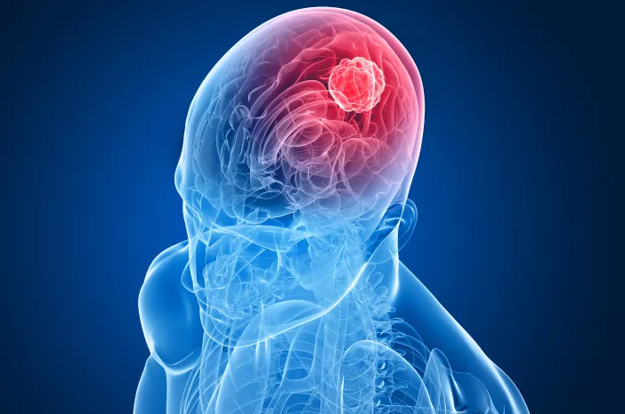 Cara Pencegahan Tumor Otak yang Perlu Diketahui