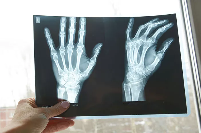 Tindakan Apa Saja yang Membutuhkan C Arm Radiography Fluoroscopy?
