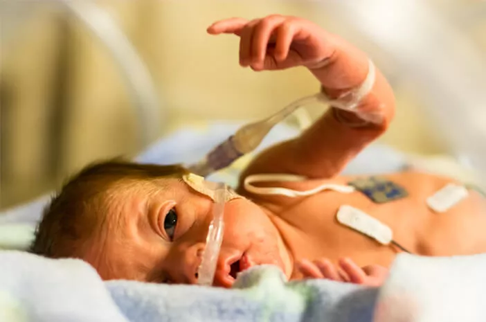 Pengobatan Sindrom Edward pada Bayi yang Baru Lahir