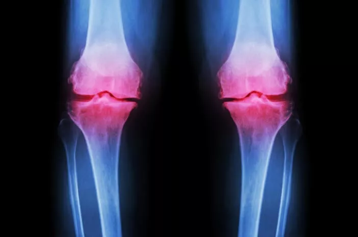 Mengapa Perempuan Lebih Berisiko Terkena Osteoartritis?