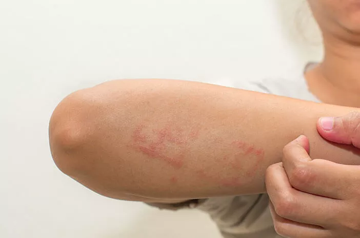Perlu Waspadai Faktor yang Dapat Menyebabkan Dermatitis Atopik