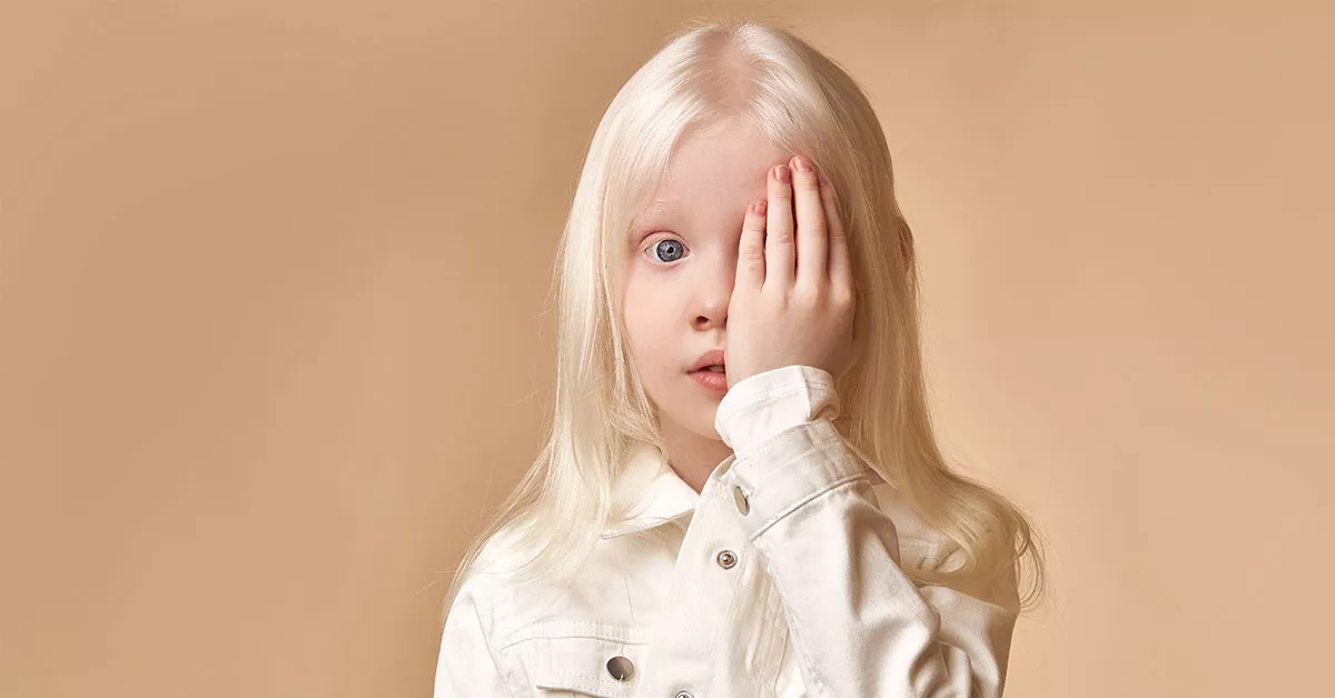 Mitos atau Fakta, Albinisme Disebabkan dari Faktor Genetik