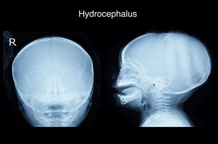 Inilah yang Terjadi pada Kepala yang Terkena Hidrosefalus