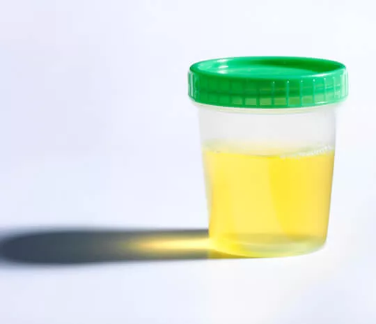Ketahui Cara Tes Urine Mendiagnosis Striktur Uretra
