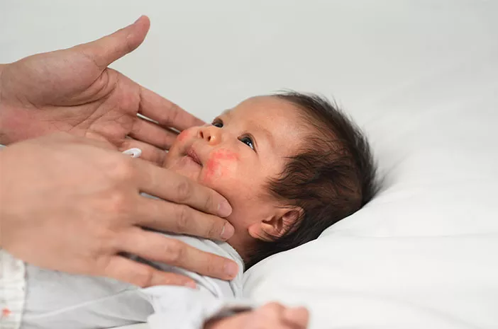 Cara Mengatasi Infeksi Kulit yang Terjadi pada Bayi