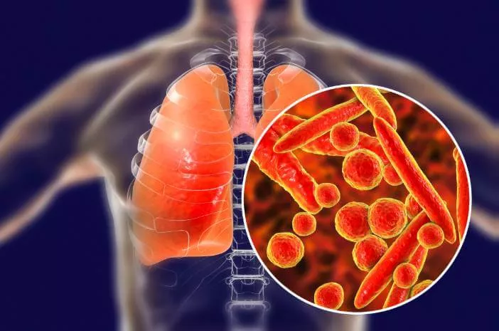 Kenali Penjelasan Tentang Bakteri Pneumonia