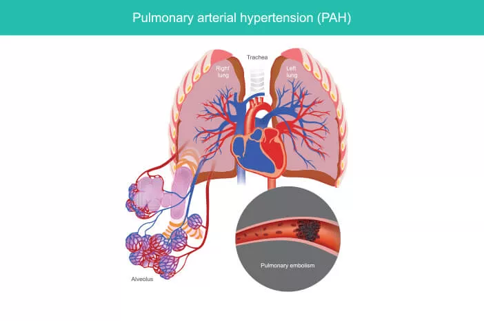 Pemeriksaan untuk Deteksi Hipertensi Pulmonal