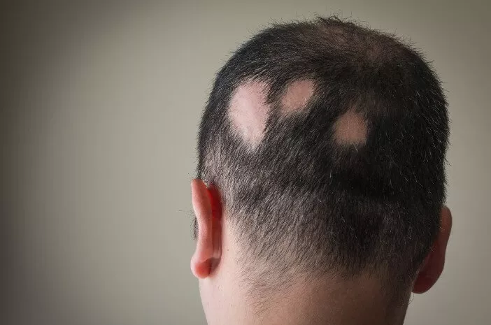 Kenali Perawatan Rumahan untuk Atasi Alopecia Areata