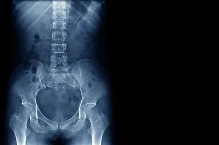3 Jenis Pemeriksaan untuk Diagnosis dari Patah Tulang Belakang