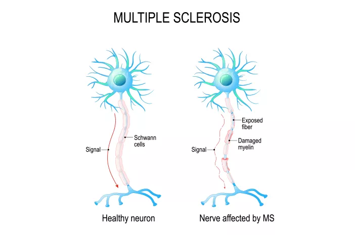 Waspada, Ini Masalah Penglihatan yang Dapat Terjadi karena Multiple Sclerosis