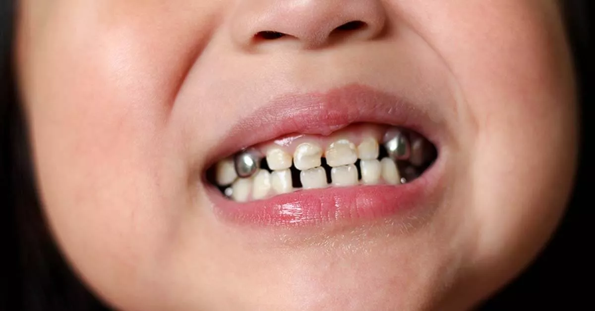 4 Cara untuk Menghilangkan Bau Mulut pada Anak