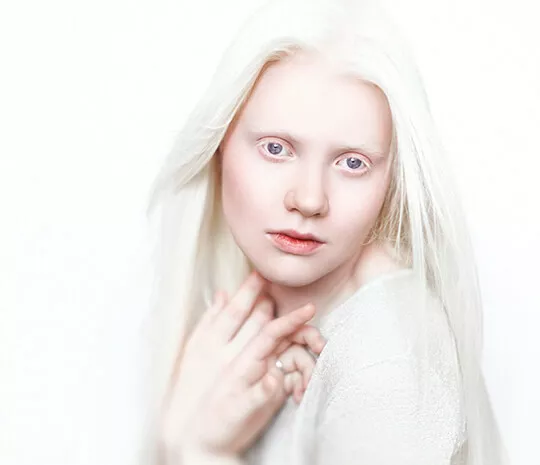Bukan karena Perkawinan Silang, Inilah 5 Fakta Albinisme