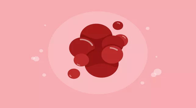 Darah Menggumpal Saat Menstruasi, Normalkah?
