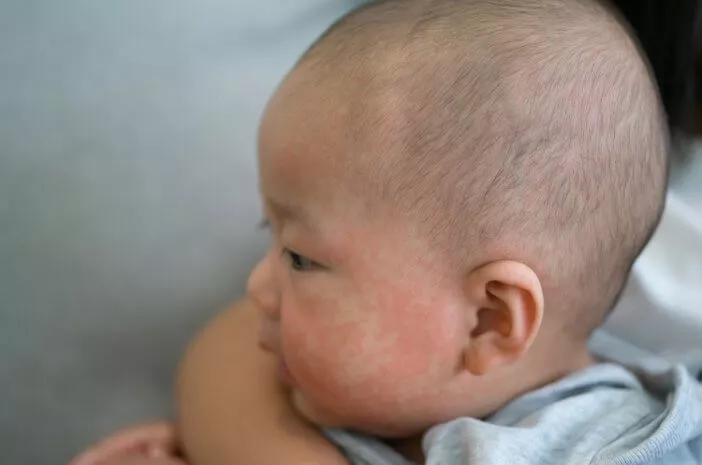 Ruam Tiba-Tiba pada Bayi, Waspada Dermatitis Atopik