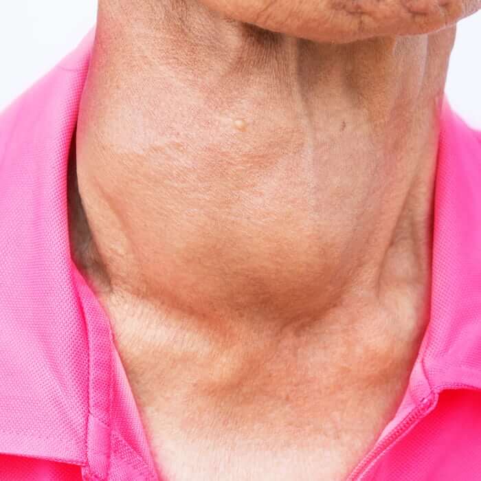Penyebab kelenjar tiroid di leher bengkak