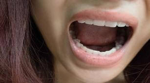   Begini Diagnosis untuk Deteksi Oral Thrush dengan Tepat 