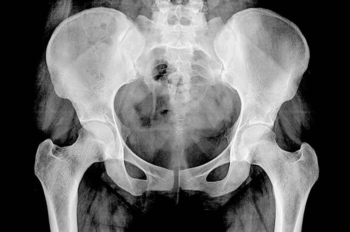 Begini Diagnosis yang Tepat untuk Deteksi Avascular Necrosis Begini Diagnosis yang Tepat untuk Deteksi Avascular Necrosis