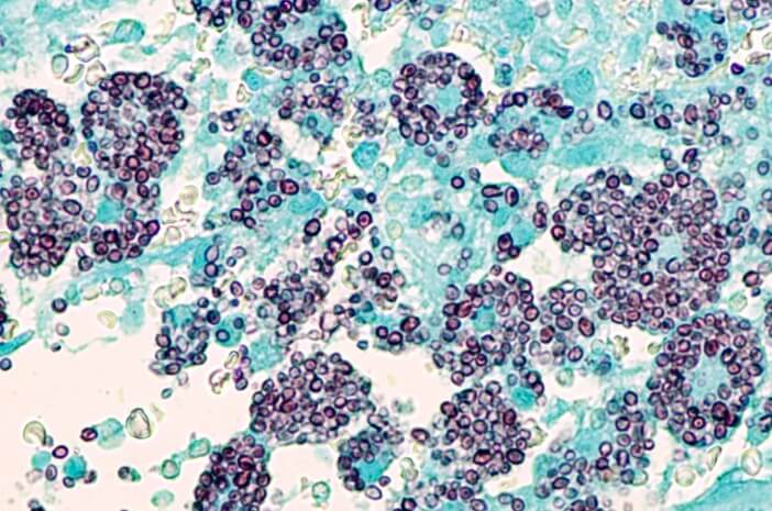 Begini Pemeriksaan Fisik untuk Diagnosis Histoplasmosis