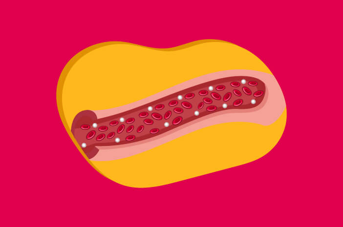 Benarkah Koarktasio Aorta Tidak Bisa Dicegah?