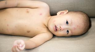 Waspadai Cacar Air Picu Sindrom Reye pada Anak
