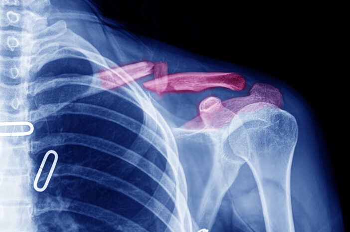 Bisakah Penanganan Patah Tulang Selangka Tanpa Operasi?